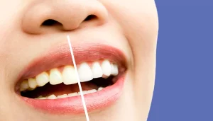 تفاوت لمینت و کامپوزیت دندان